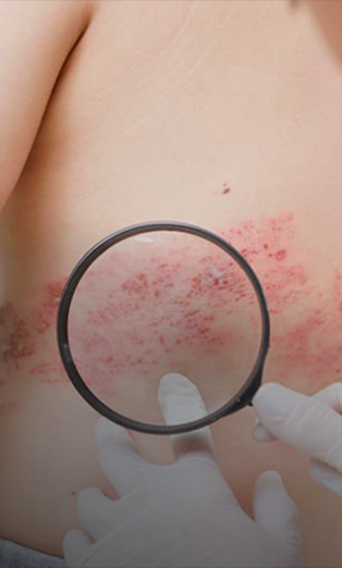 Herpes Zoster