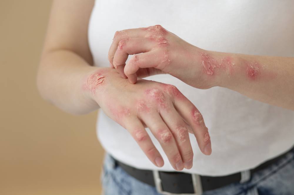 Você Já Ouviu Falar em Herpes Zóster? Você Já Ouviu Falar em Herpes Zóster?