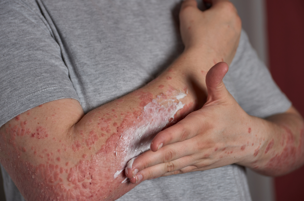 Vacina contra herpes-zóster reduz em 23% risco cardiovascular, diz estudo