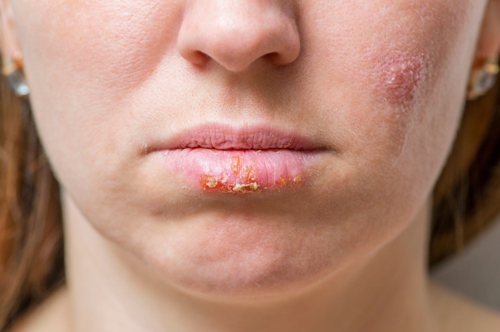 Vacina contra herpes-zóster reduz risco cardiovascular